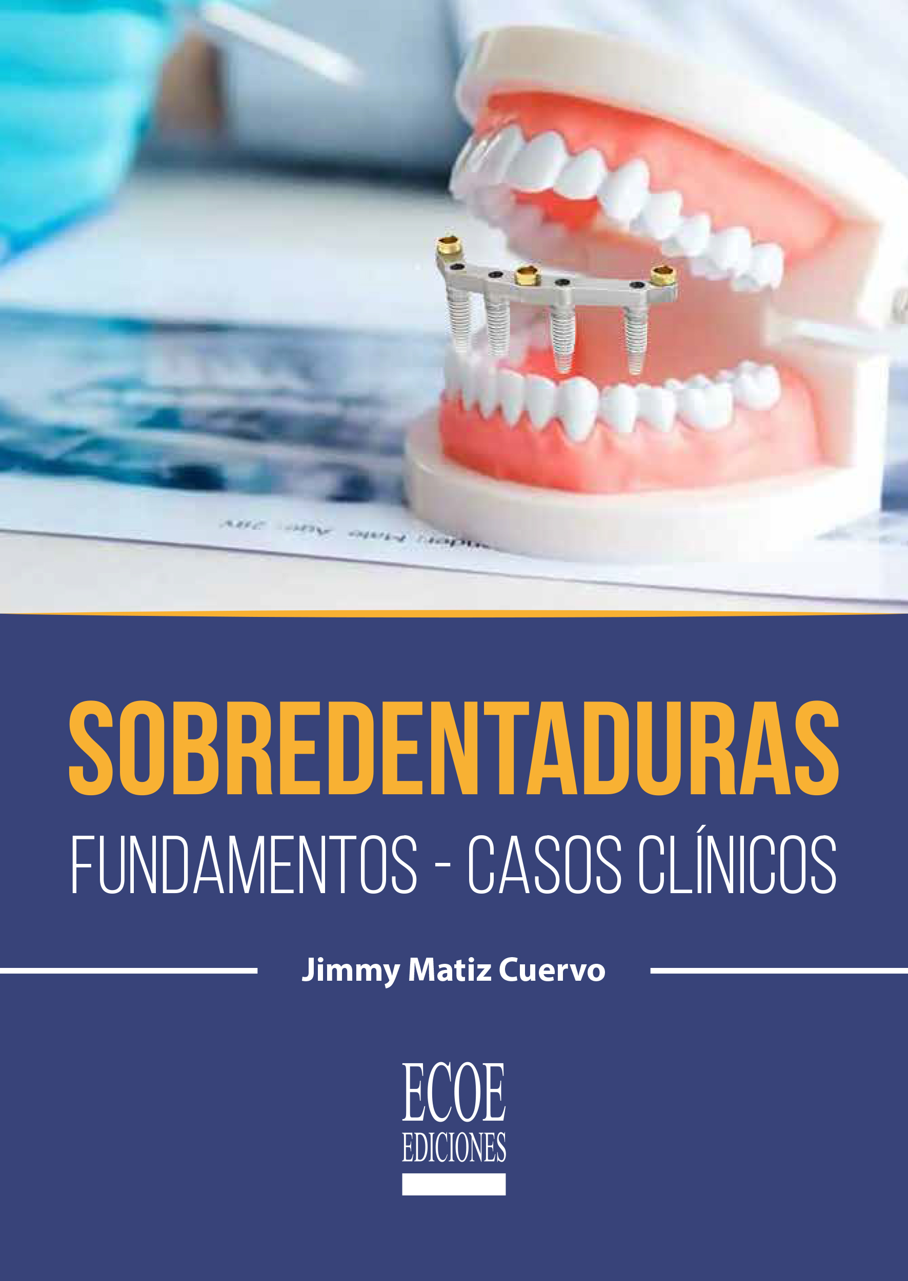 Sobredentaduras final